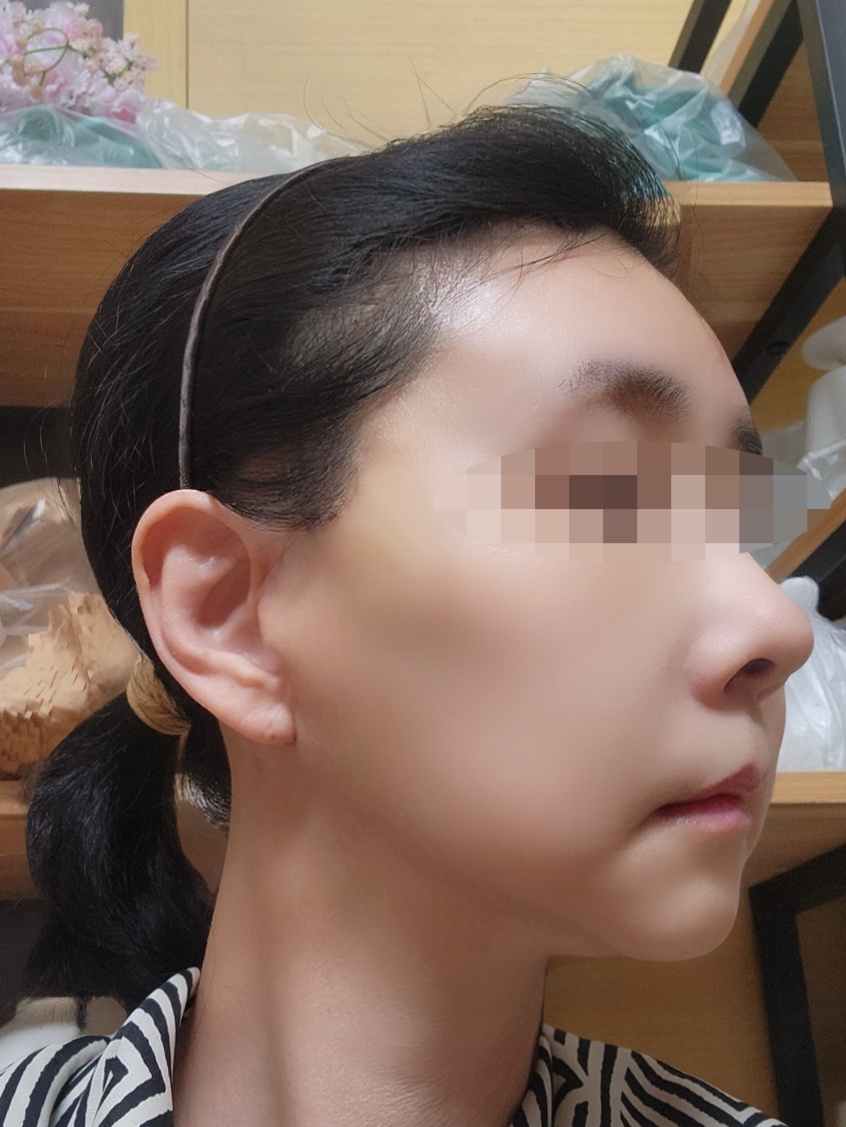 안면거상, 이마거상 수술 후