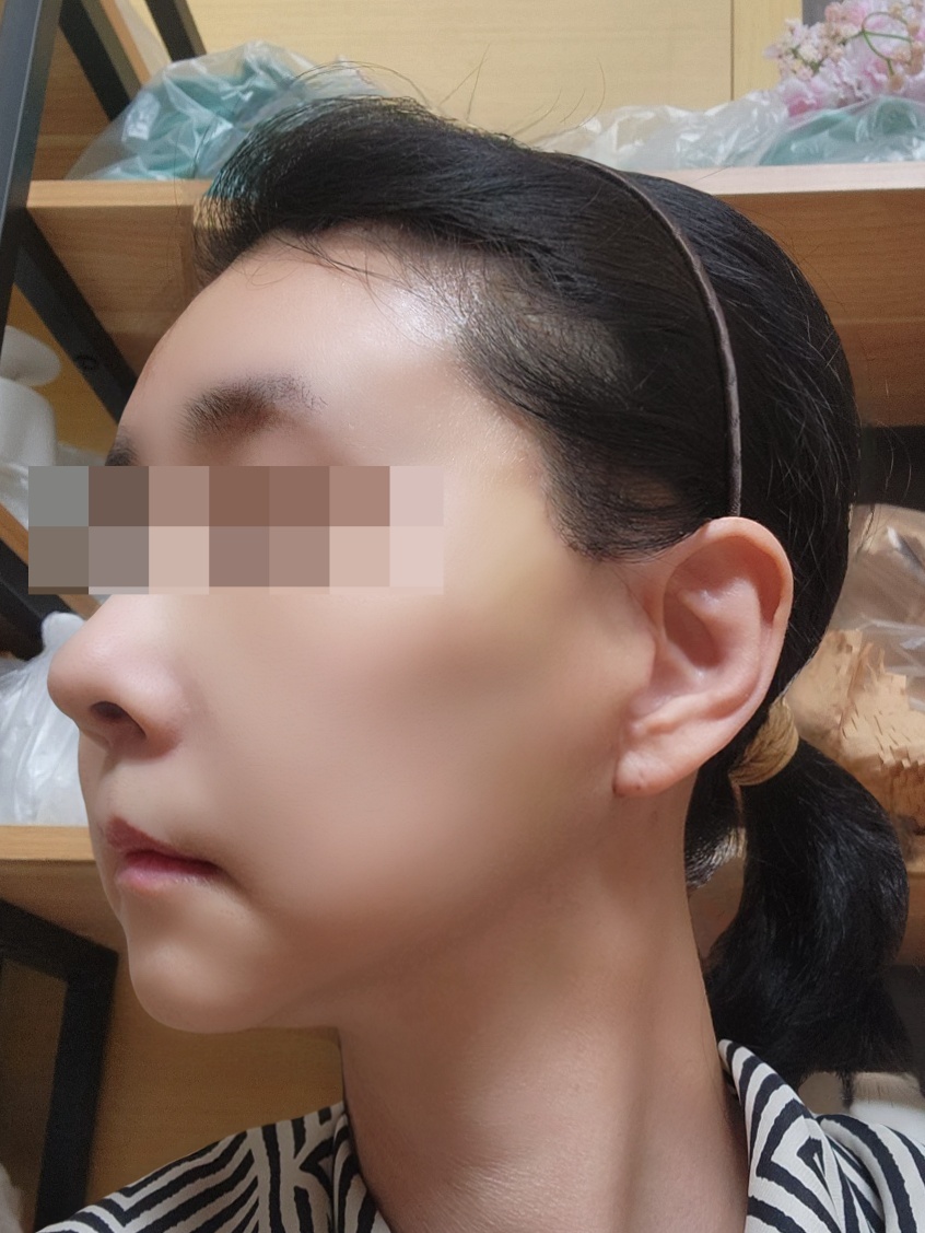 안면거상, 이마거상 수술 후