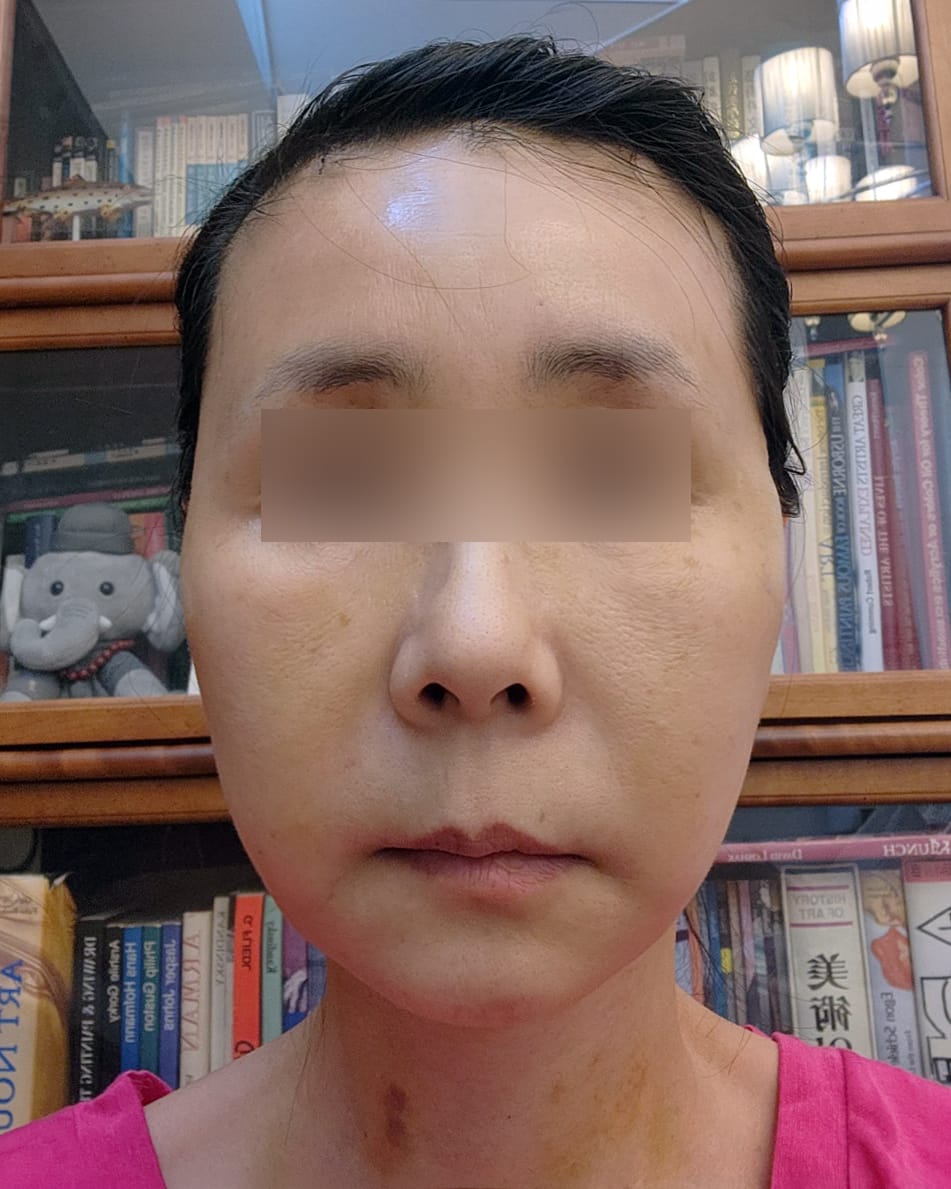 안면거상, 이마거상 수술 후