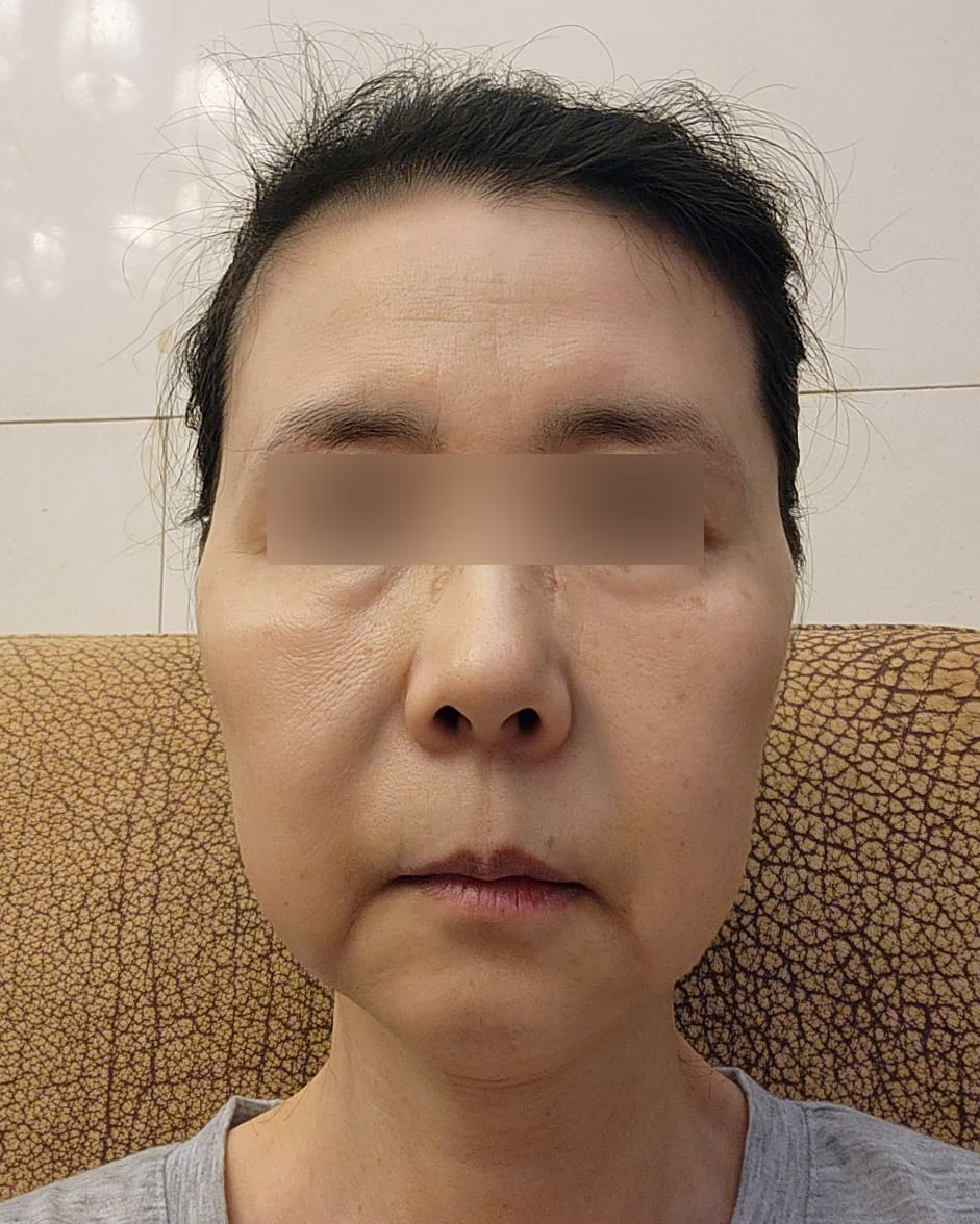 안면거상, 이마거상 수술 전