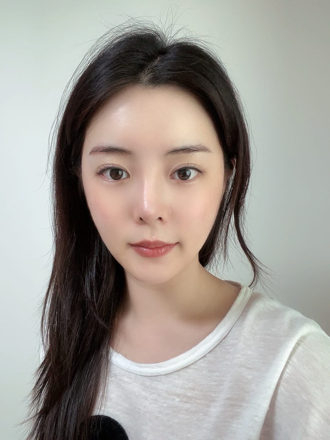 얼굴지방흡입 수술 후