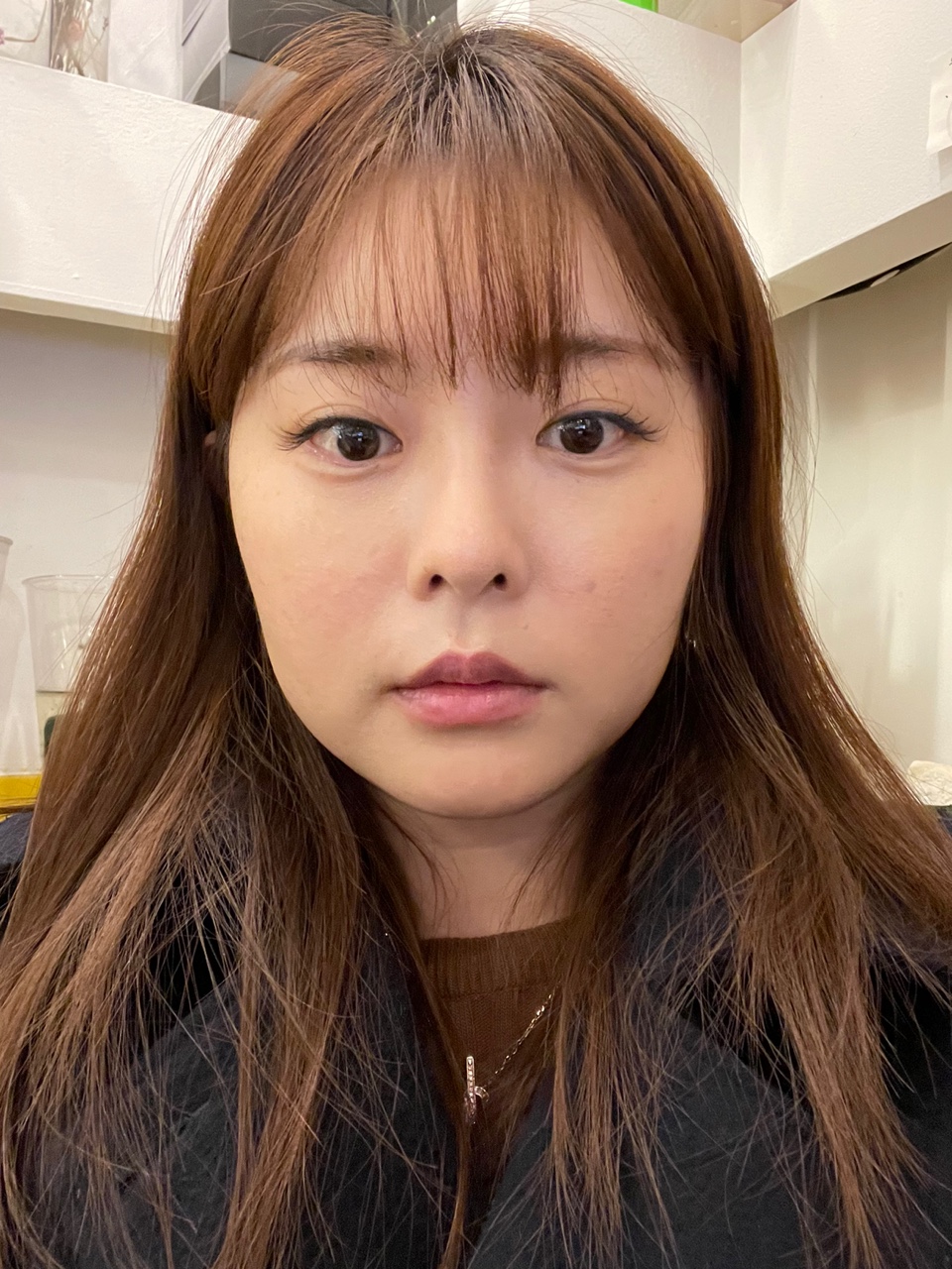 얼굴지방흡입 수술 전