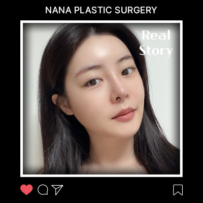 얼굴지방흡입 리얼후기 썸네일