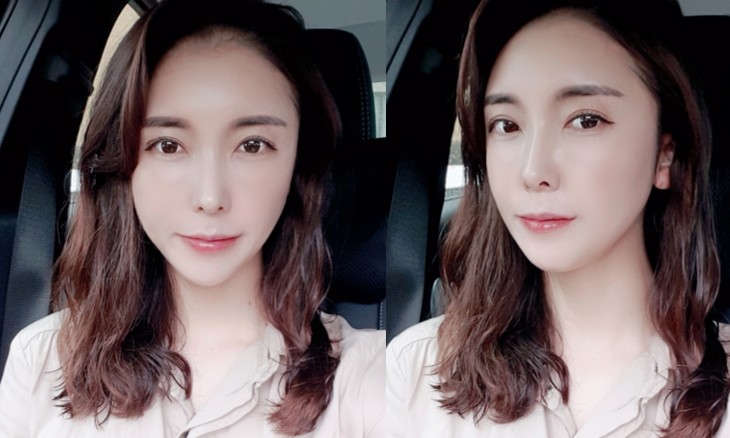 얼굴지방이식 수술 후