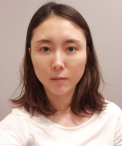얼굴지방이식 수술 전