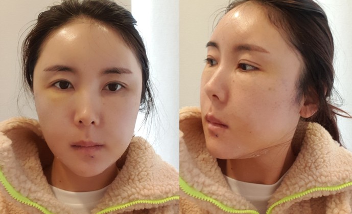 얼굴지방이식 수술 전