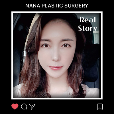 얼굴지방이식 회복 과정 리얼후기 썸네일