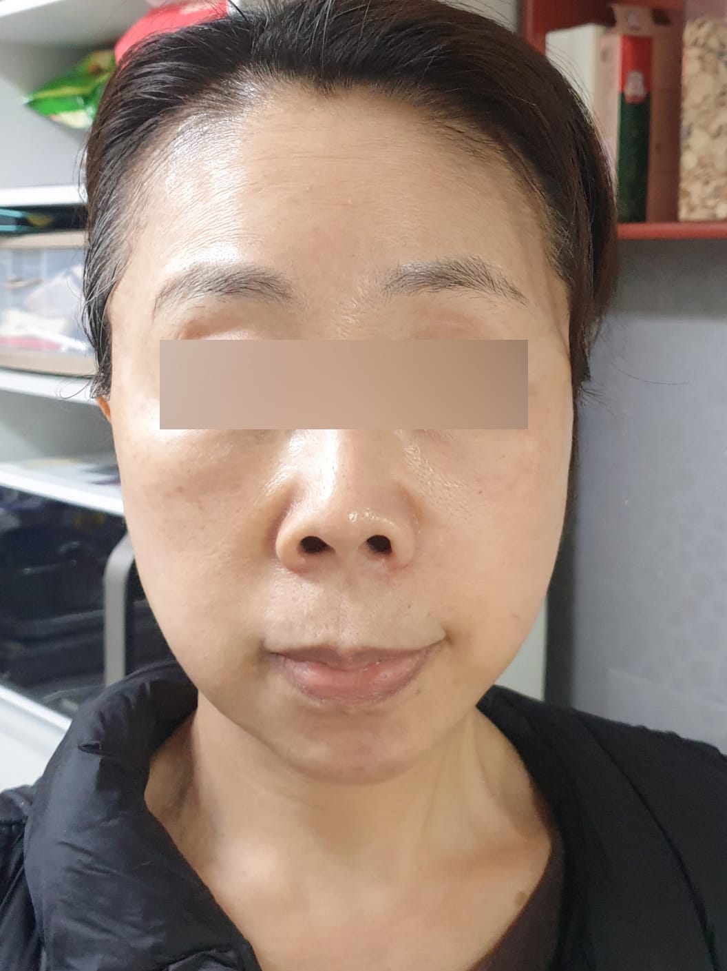 안면거상 수술 후