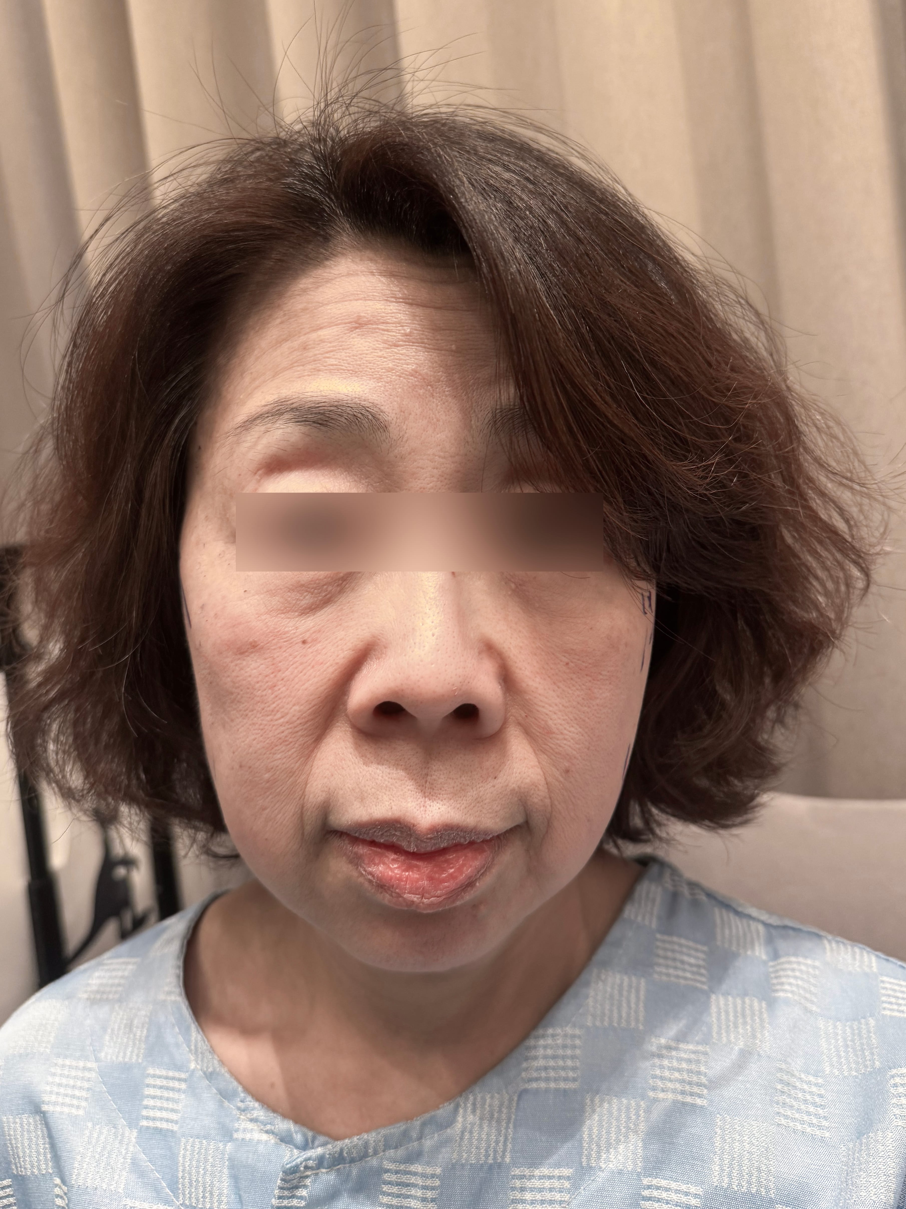 안면거상 수술 전