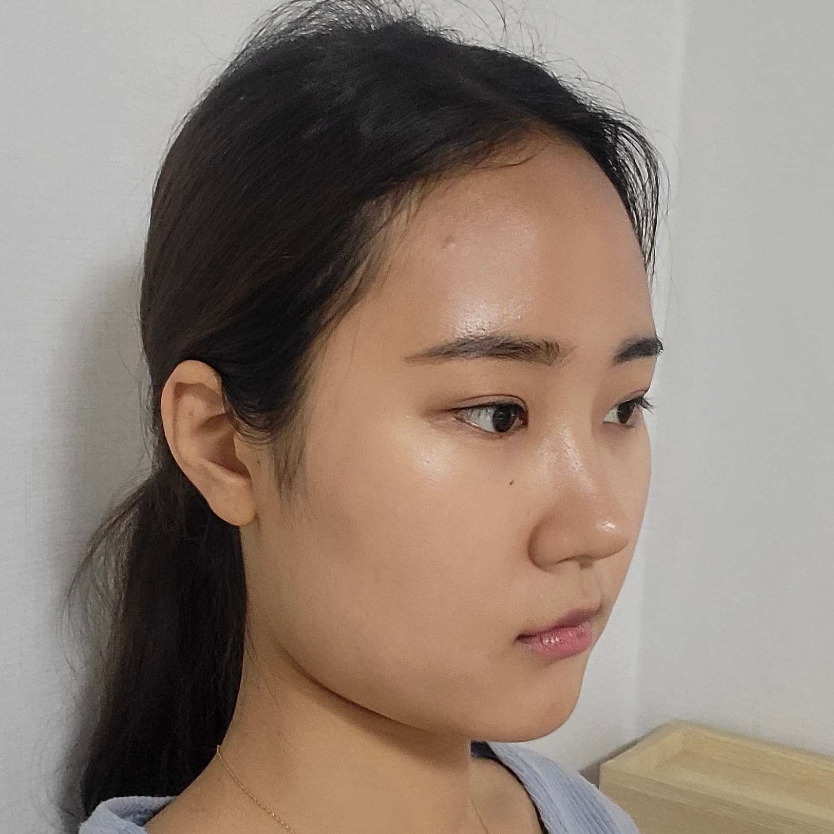 얼굴지방흡입 수술 전
