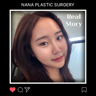 얼굴지방흡입 전후 변화 리얼후기 썸네일
