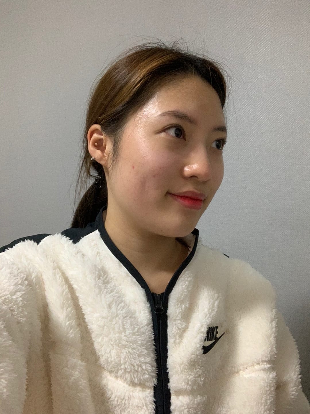 얼굴지방이식 수술 전