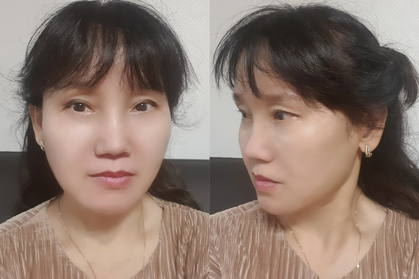 민트실리프팅 수술 후