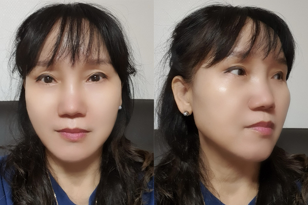 민트실리프팅 수술 후