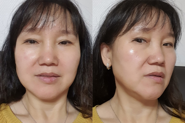 민트실리프팅 수술 전
