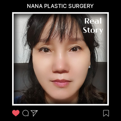 민트실리프팅 리얼후기 썸네일