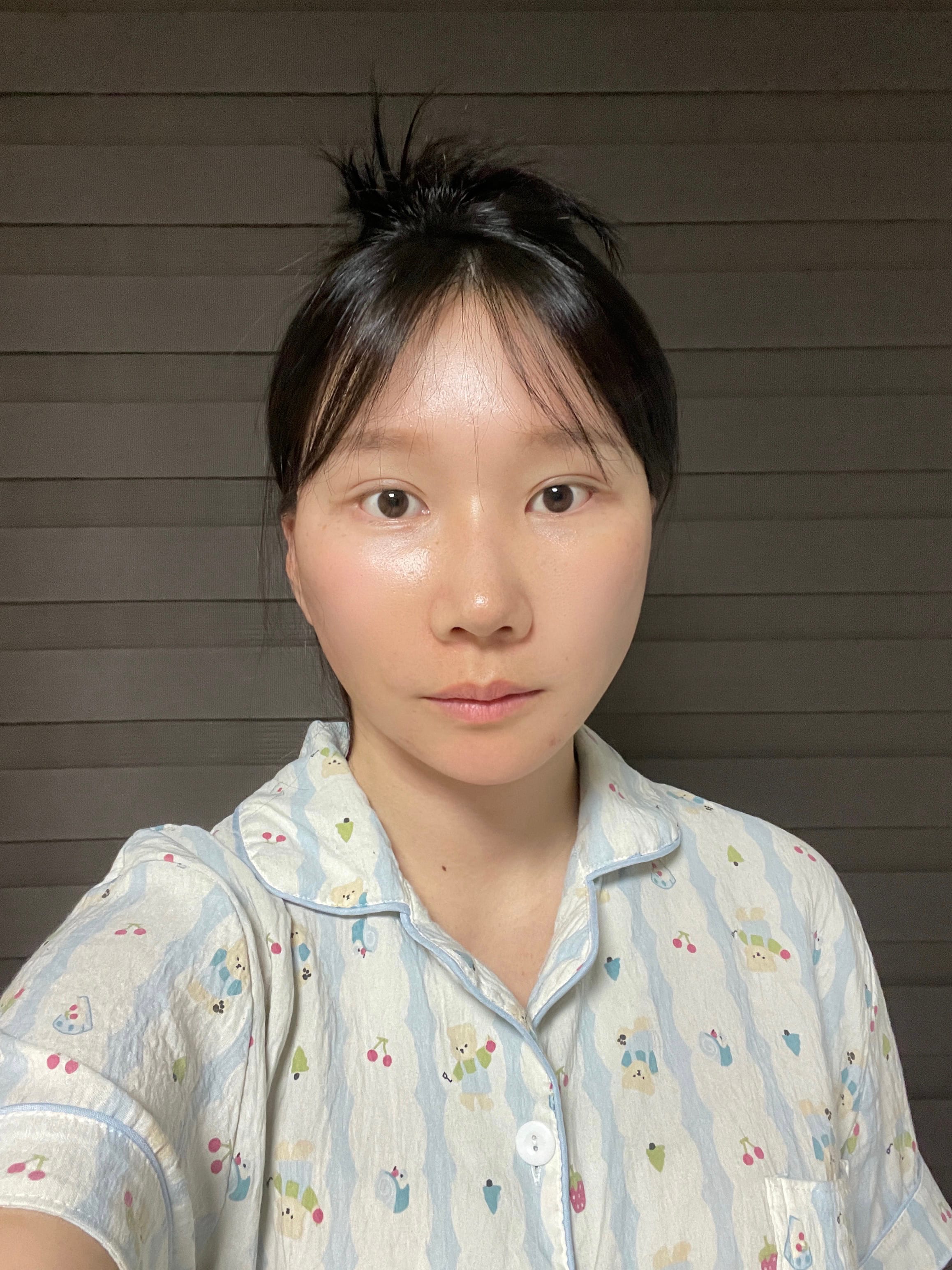 안면거상 수술 후