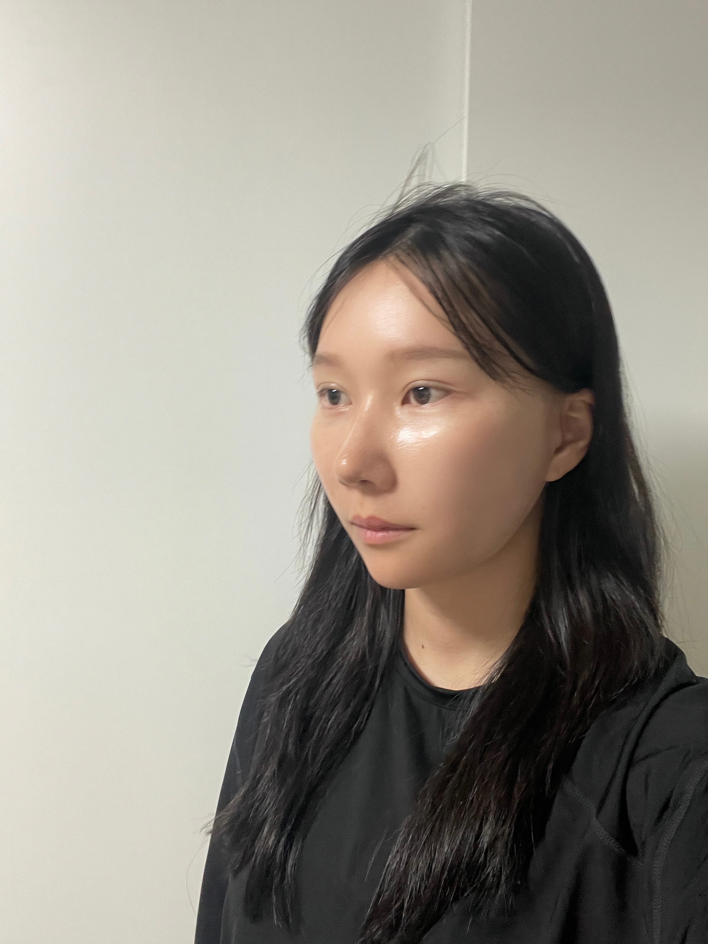 안면거상 수술 후