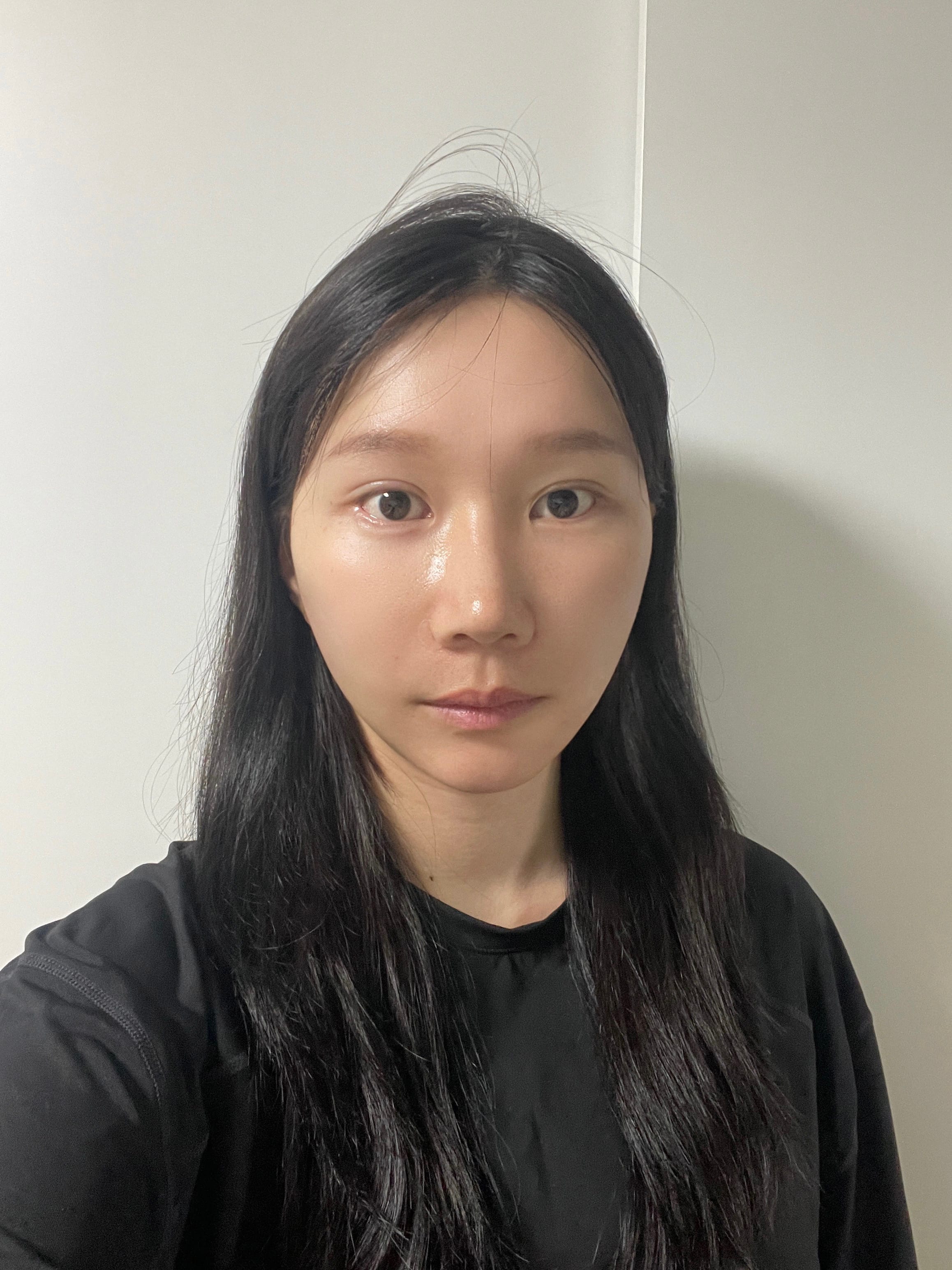 안면거상 수술 후
