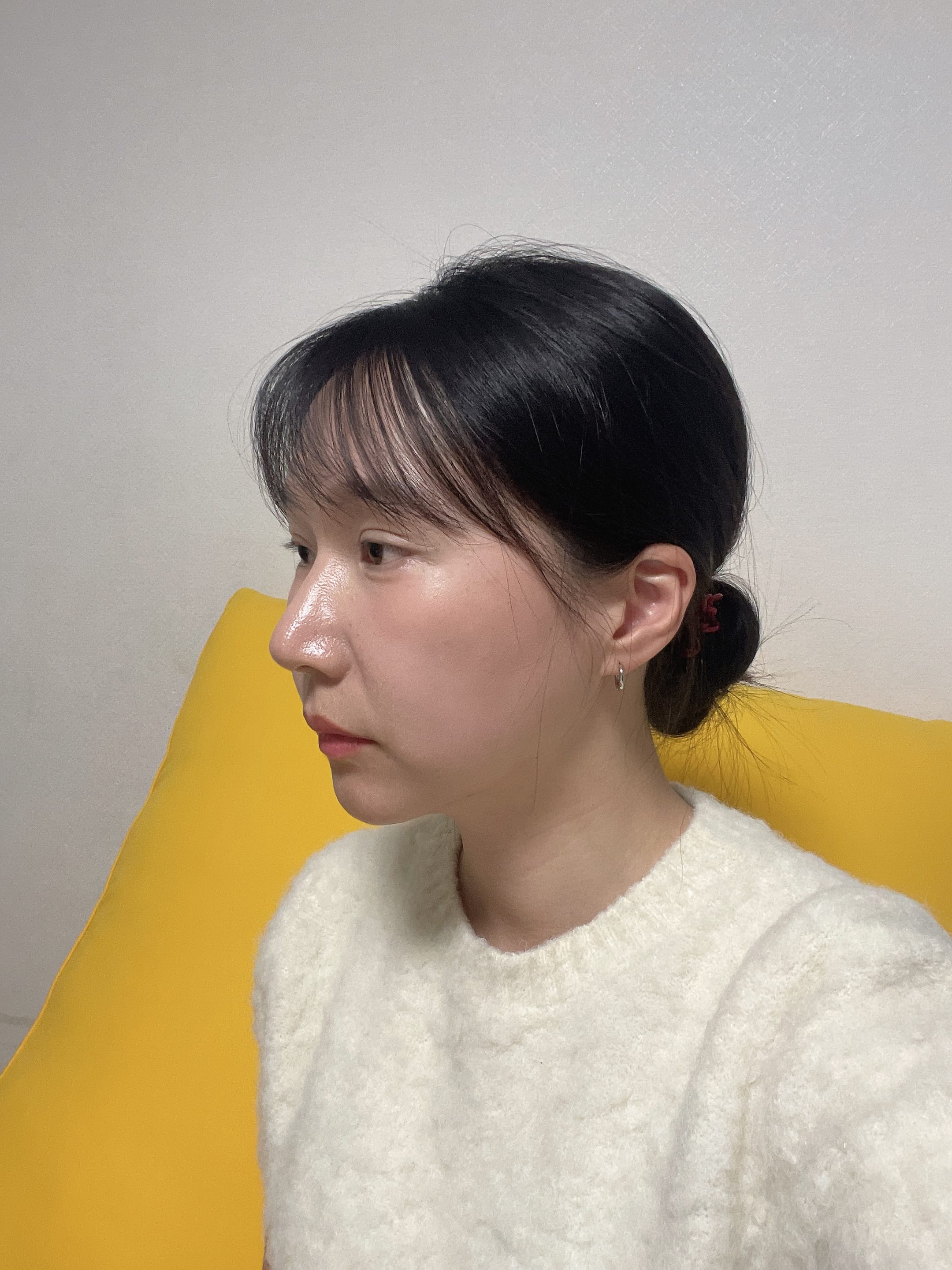 안면거상 수술 전