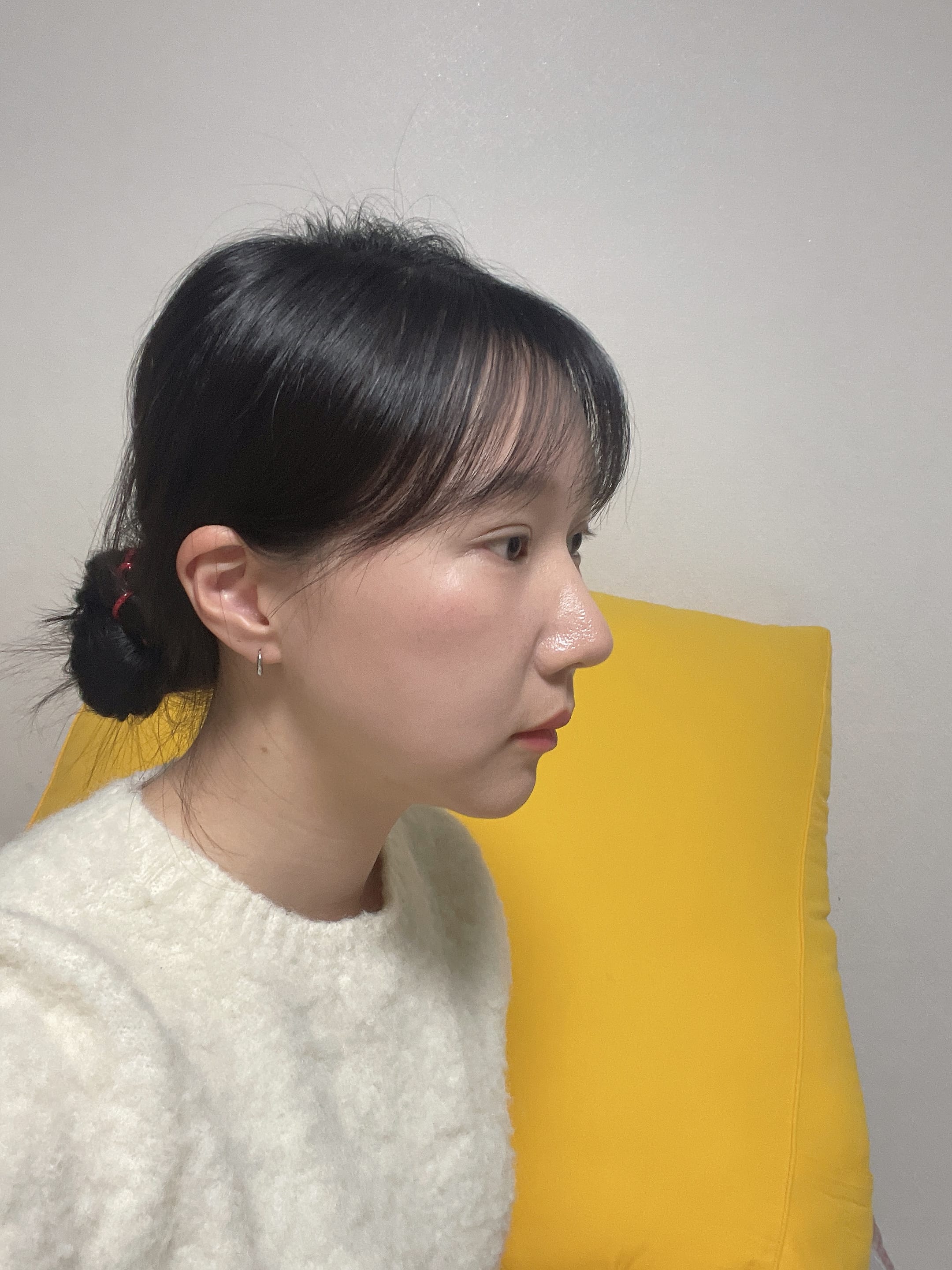 안면거상 수술 전