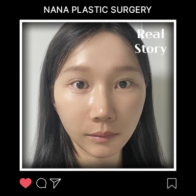 팔자와 입가 주름, 3주 만에 달라진 안면거상 회복 일기 썸네일
