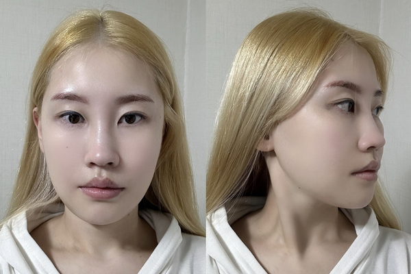 민트실리프팅, 안면윤곽 수술 후