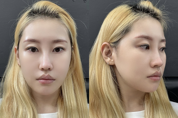 민트실리프팅, 안면윤곽 수술 후