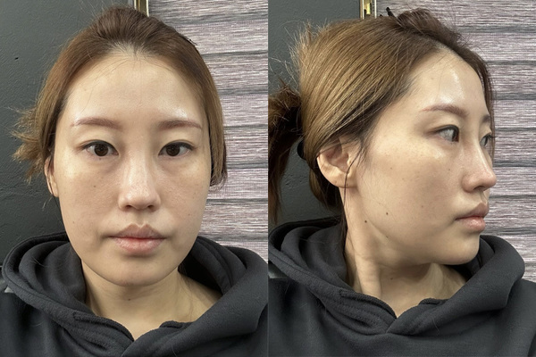 민트실리프팅, 안면윤곽 수술 전