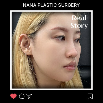 민트실리프팅·안면윤곽 리얼후기 썸네일
