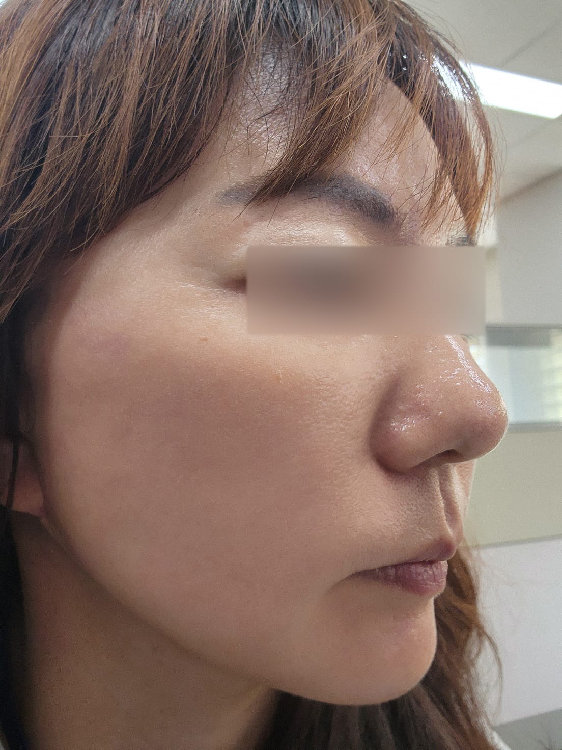 안면거상 수술 후