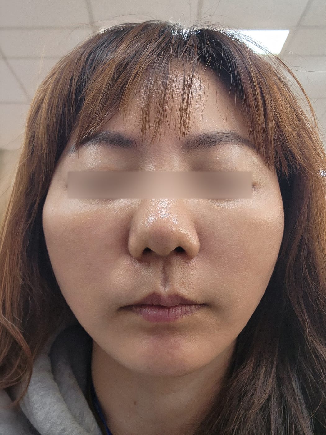 안면거상 수술 후