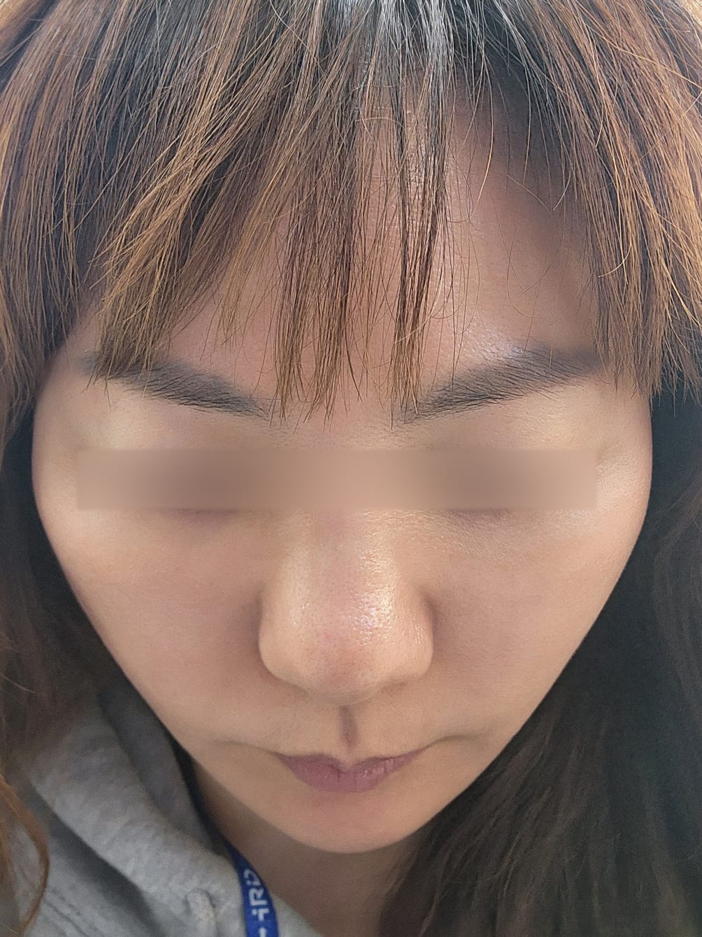 안면거상 수술 후