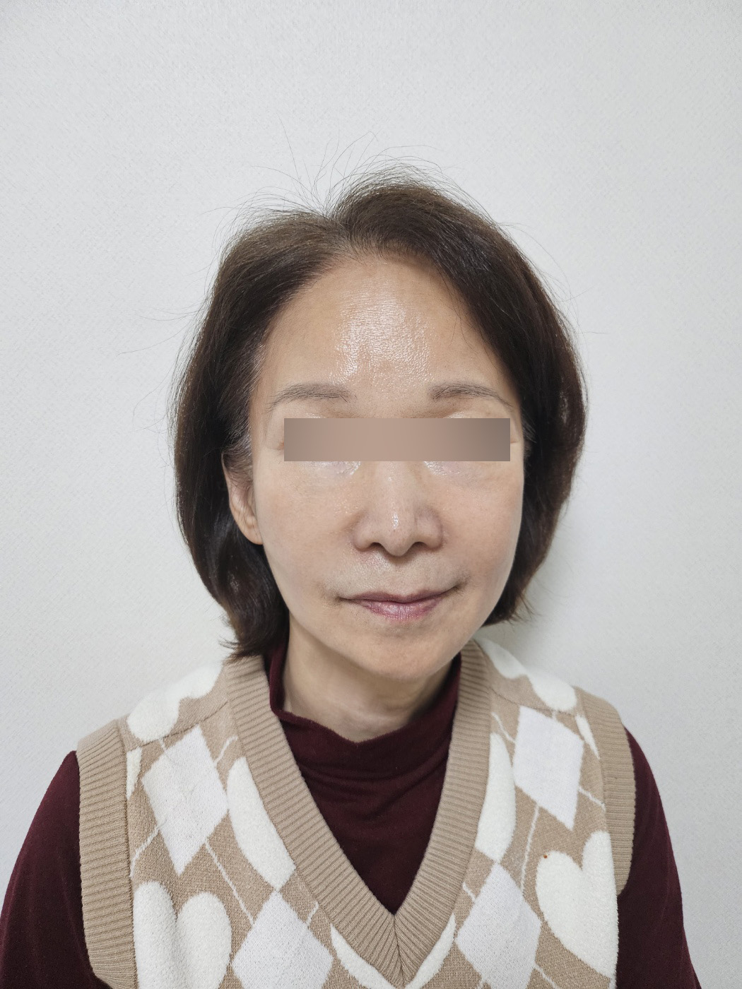 안면거상 수술 후