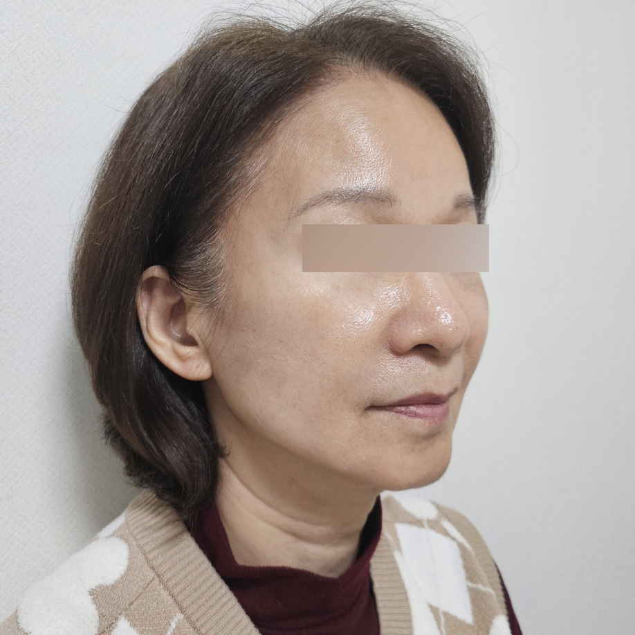 안면거상 수술 후