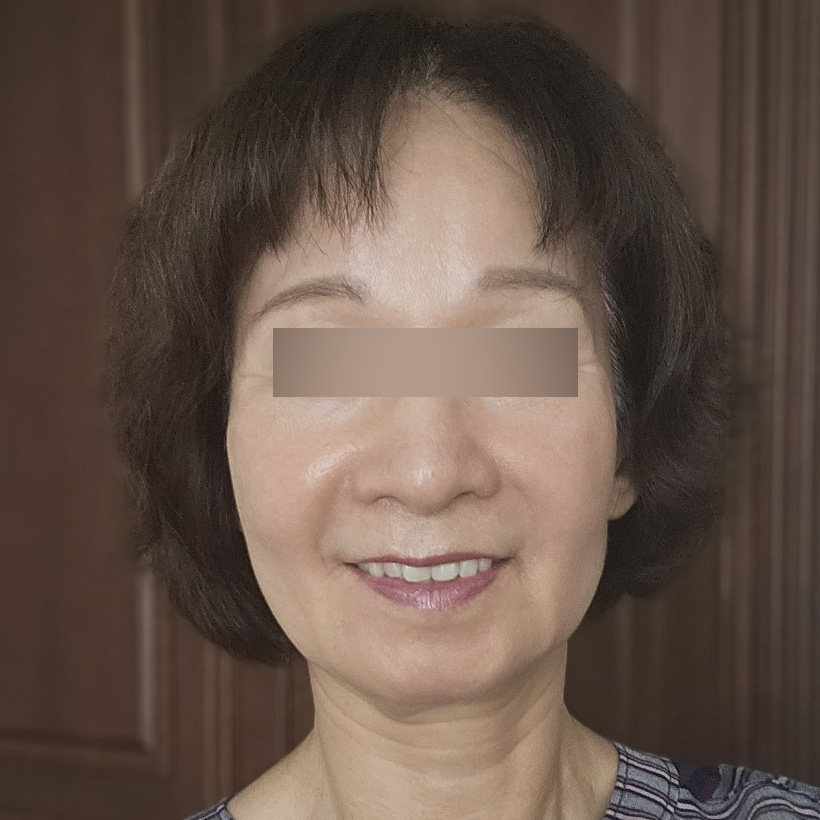 안면거상 수술 전