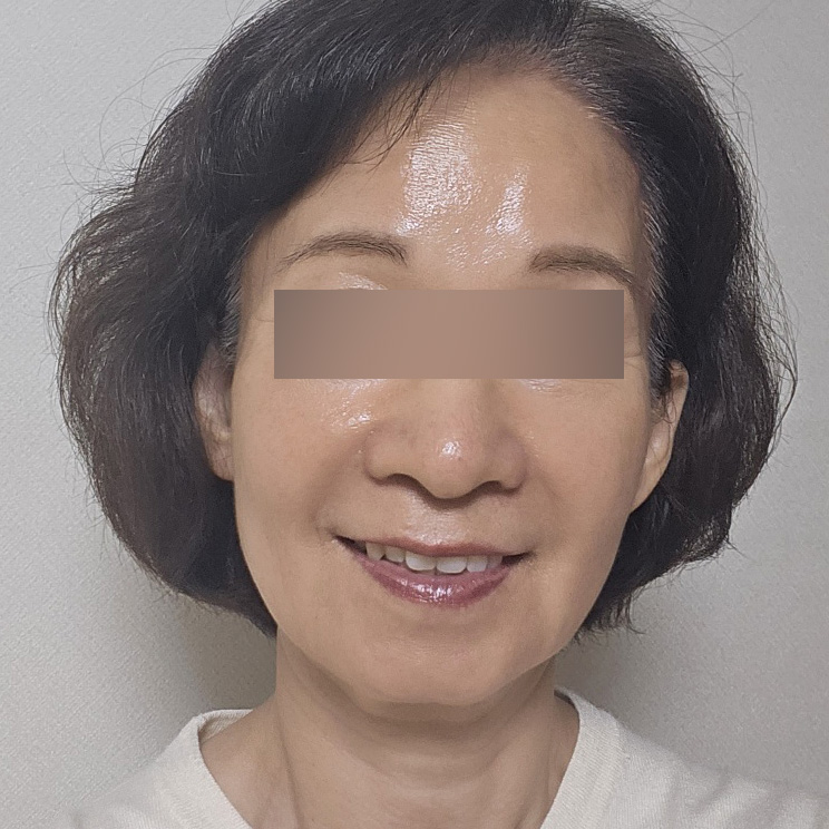 안면거상 수술 전