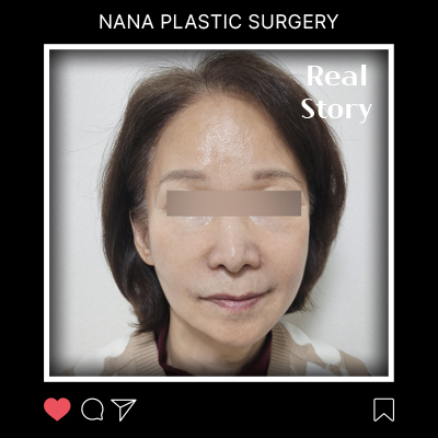 안면거상 회복 과정 리얼후기 썸네일