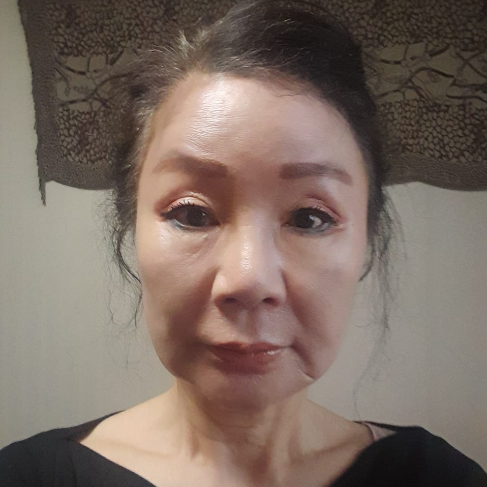 안면거상 수술 전