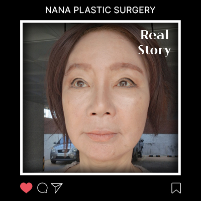 안면거상으로 되찾은 10년, 리얼후기 썸네일