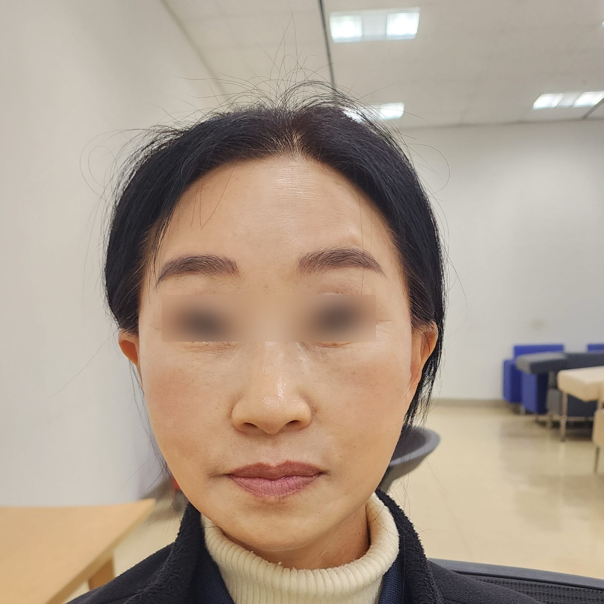 안면거상 수술 후