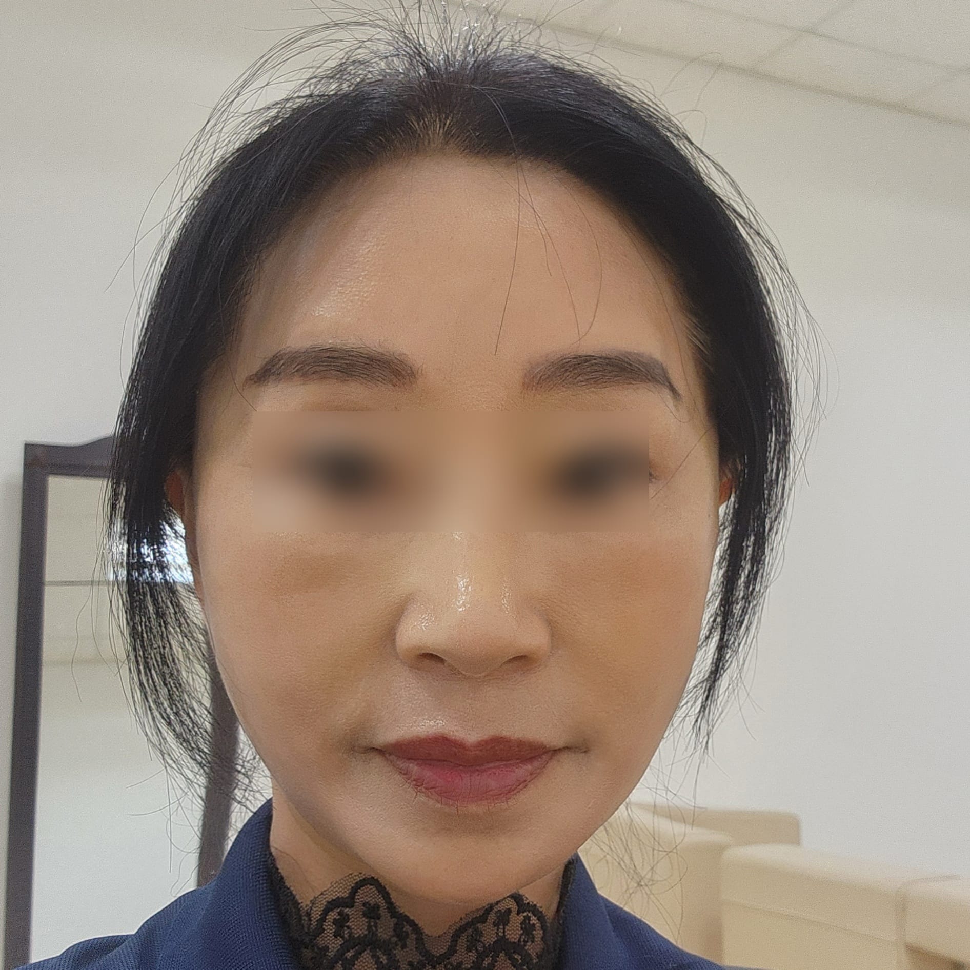 안면거상 수술 후