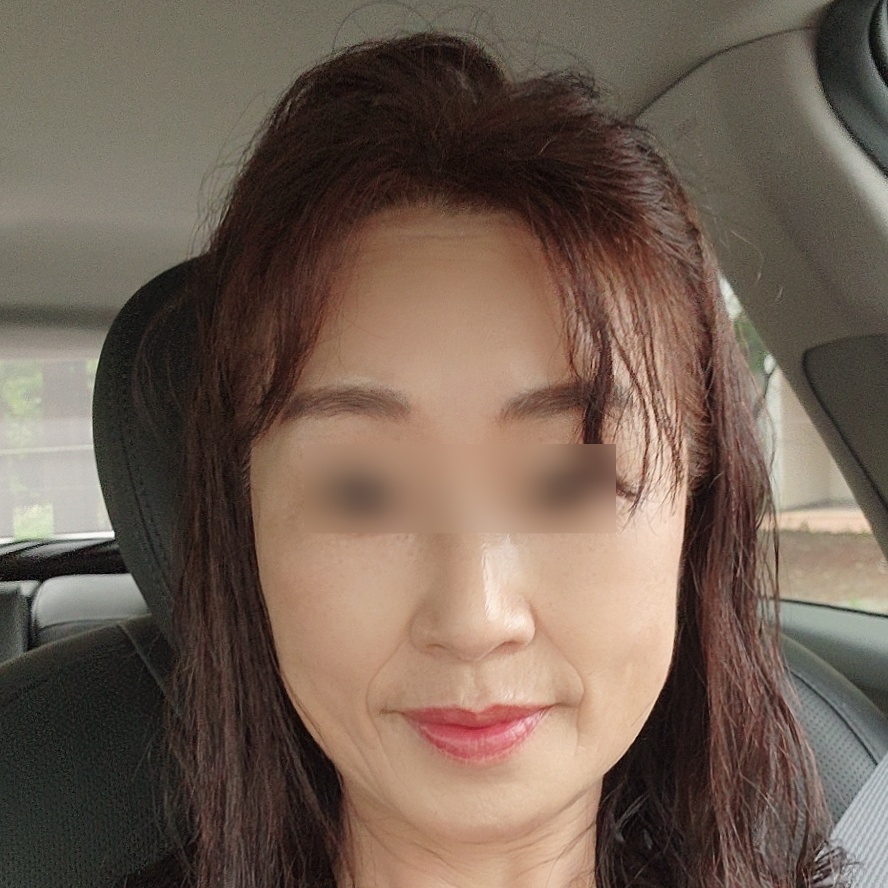 안면거상 수술 전