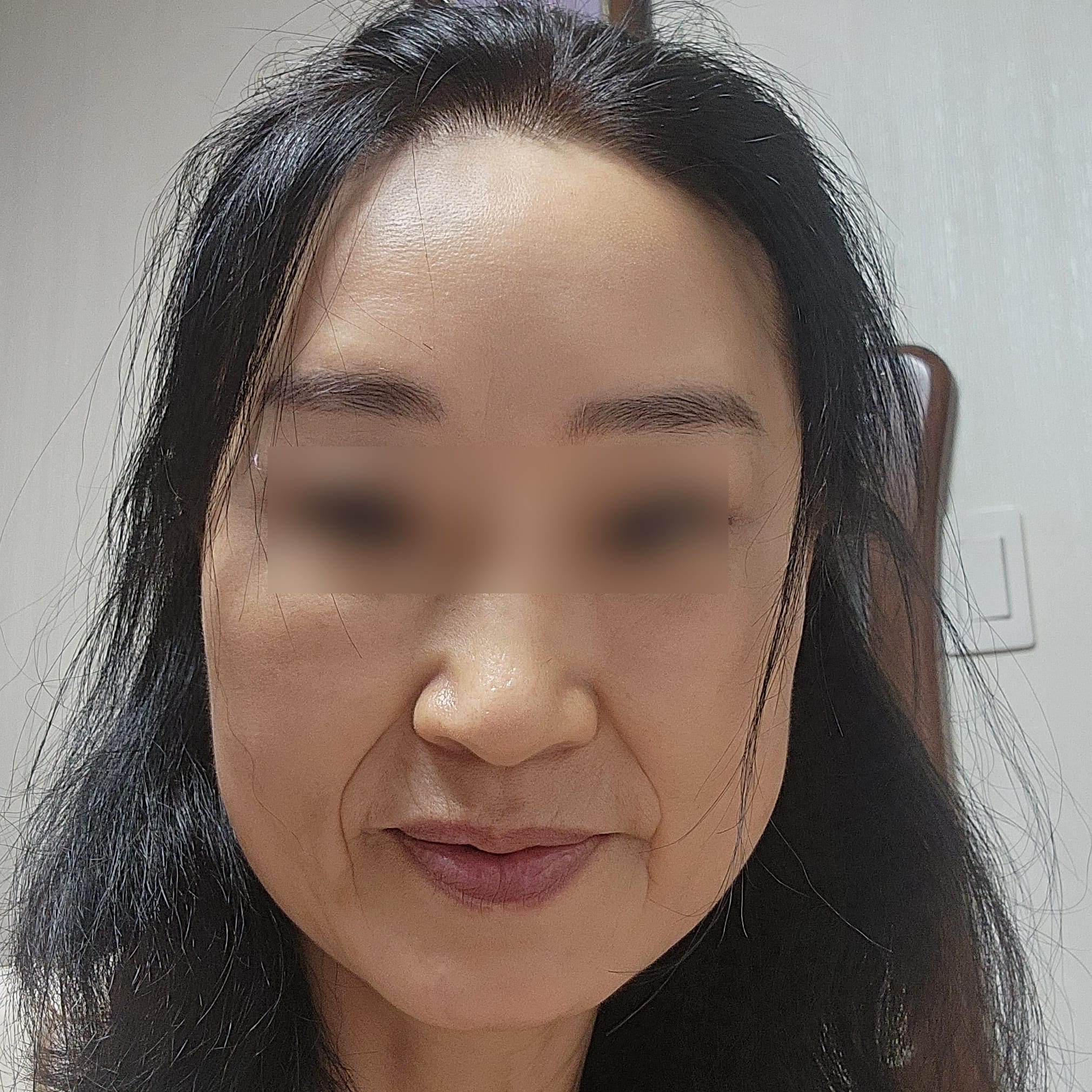 안면거상 수술 전