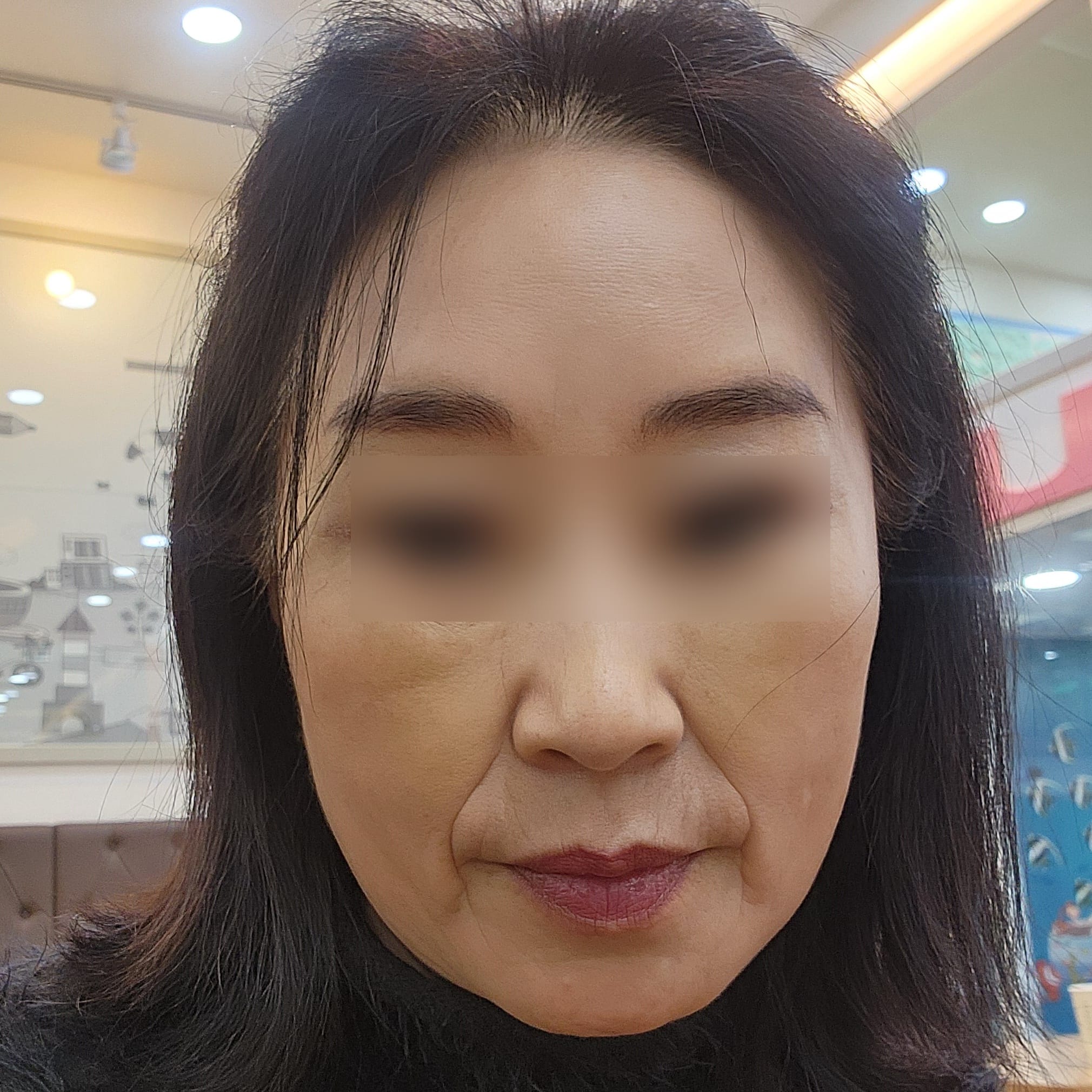 안면거상 수술 전