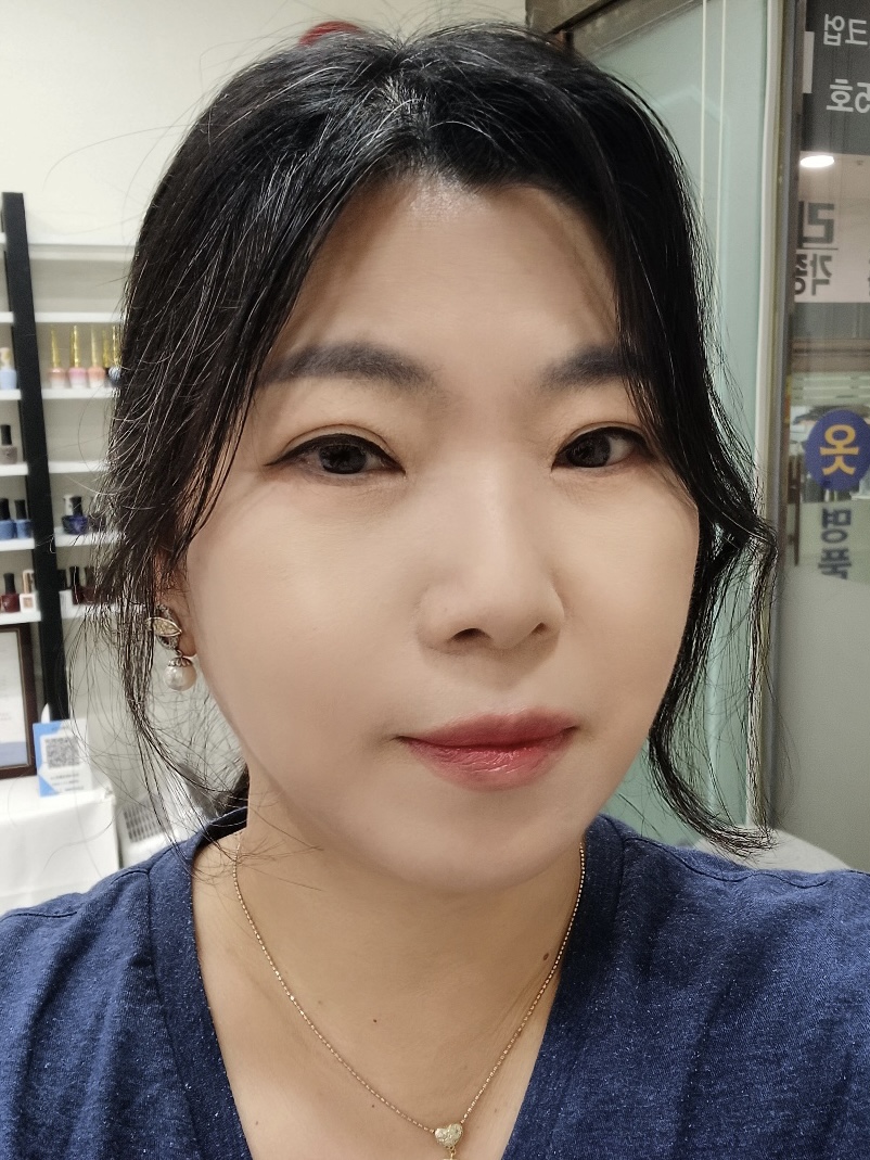 풀안면거상, 지방이식 수술 후