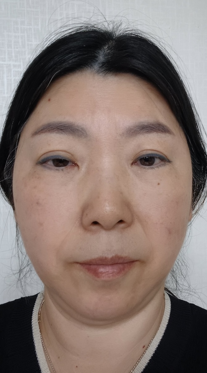 풀안면거상, 지방이식 수술 전