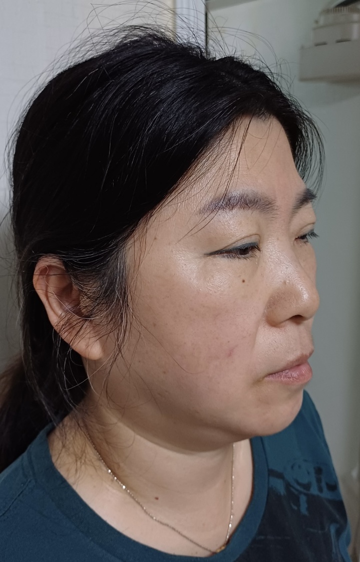풀안면거상, 지방이식 수술 전