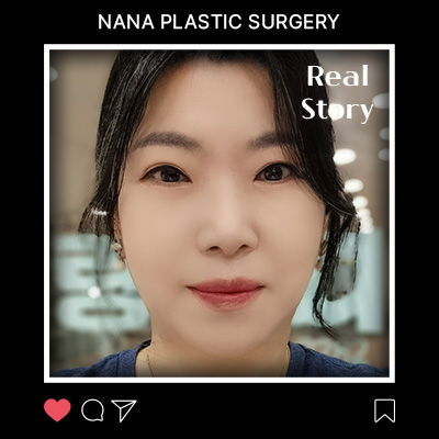 풀안면거상·지방이식 리얼후기 썸네일