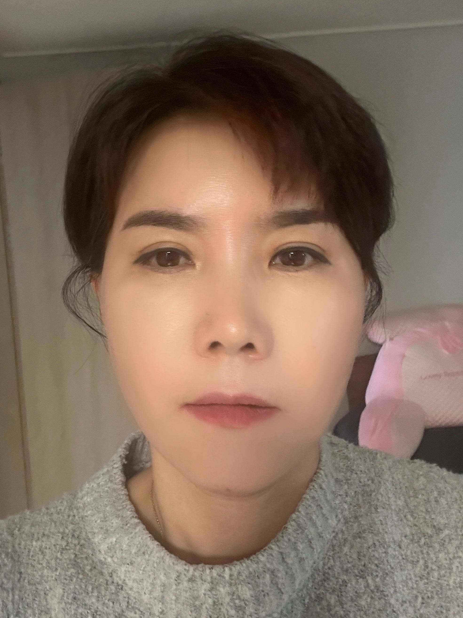 미니거상 수술 후